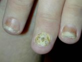 Лечение псориаза ногтей в домашних условиях
