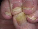 Лечение ногтей псориаз
