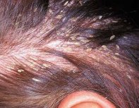 Эффективное лечение жирной себореи волосистой части головы 