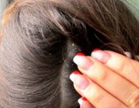 Как правильно подобрать шампунь от себореи кожи головы