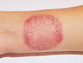 Микроспория гладкой кожи: признаки и лечение