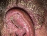 Псориаз в ушах лечение и диагностика