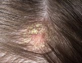 Жирная себорея кожи головы: лечение патологии